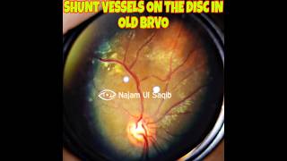 Shunt Vessels On the DiscAlso Hard Exudates In A Patient with an Old Branch Retinal Vein Occlusion [upl. by Alroi112]