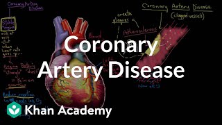 What is coronary artery disease  Circulatory System and Disease  NCLEXRN  Khan Academy [upl. by Dever610]