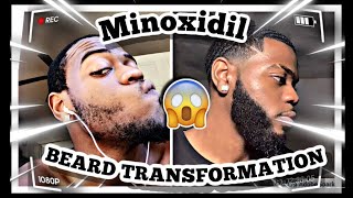 Minoxidil How Does Minoxidil Work For Hair Regrowth Results  Trichologist William Gaunitz [upl. by Yvor272]