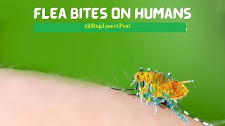 Get Rid of Flea Bites On Humans  Natural and Home Remedies [upl. by Bess903]