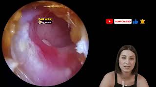 how to remove ear remove ear wax ear wax murine ear wax removal system how to remove ear wax [upl. by Iridis]