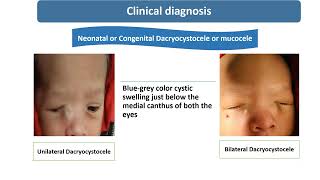 Congenital Dacryocystocele  Spot Diagnosis  11  Pediatrics [upl. by Trent]