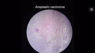 Thyroid gland  AnaplasticUndifferentiated carcinoma [upl. by Hubie]