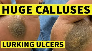 Huge Calluses Lurking Ulcers [upl. by Duj]