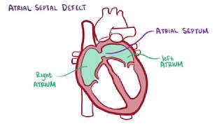 Atrial septal defect causes symptoms diagnosis treatment pathology [upl. by Ycats]