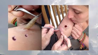 Mangoworm Bot fly removed from Woman [upl. by Mcquade895]