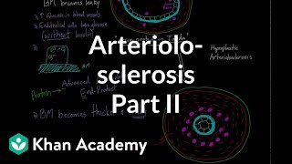 Arteriolosclerosis  part 2  Circulatory system diseases  Health amp Medicine  Khan Academy [upl. by Kcirevam799]