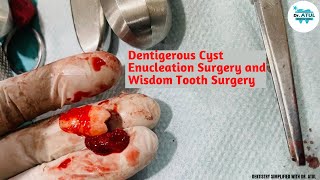 Dentigerous Cyst Enucleation Surgery and Wisdom Tooth Surgery [upl. by Aihsar929]