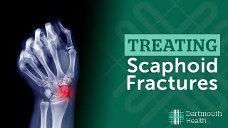 Treating Scaphoid Fractures at Dartmouth Health [upl. by Ayotan990]