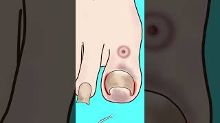 ASMR Ingrown toenail removal Treatment P1asmr animation satisfying viral shorts youtubeshorts [upl. by Eugenides]