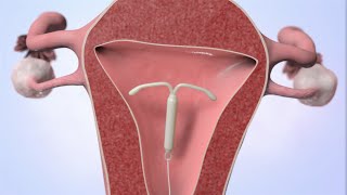 Patient Education Video Intrauterine Device IUD [upl. by Haroldson]