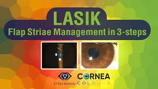 Cornea Colours  LASIK Flap Striae Management in 3Steps [upl. by Thagard]