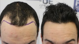 FUE Hair Transplant 2218 grafts in NW lllA  Scarring Alopecia Dr Juan Couto  FUEXPERT CLINIC [upl. by Jb]