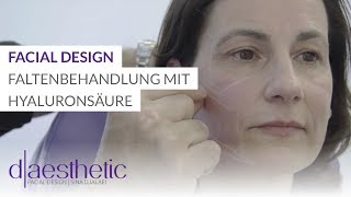 Behandlung mit Hyaluronsäure  Facial Design  daesthetic [upl. by Asikal]