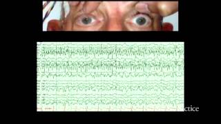 Alternating ictal and postictal nystagmus [upl. by Warga]