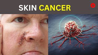 What Happens In Skin Cancer  Symptoms Causes and Treatment [upl. by Landel]