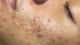 ACNE TREATMENT VU QUYNH MI Acne On Boys Check 2024 [upl. by Adnamal]