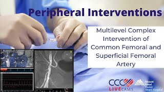 Multilevel Complex Intervention of Common Femoral and Superficial Femoral Artery [upl. by Cesaria574]