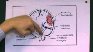 Tentorial herniation [upl. by Rushing]