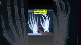 Fracture 5th Metacarpal Bone⚡️ Xray Hand xray fracture bones [upl. by Cita]