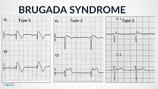 Brugada Syndrome  Pathology Types Diagnosis amp Management [upl. by Taddeusz]