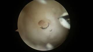 Arthroscopic Microfracture of the Knee with PowerPick [upl. by Annice722]