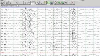 LennoxGastaut Syndrome [upl. by Krystal553]