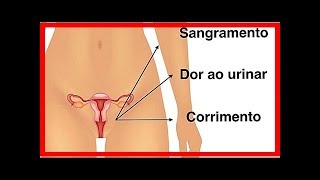 Symptome von Chlamydien bei Männern und Frauen [upl. by Riess915]