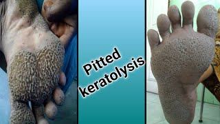 Pitted Keratolysis [upl. by Rotow581]