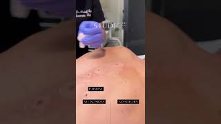 Mole Removal with Radiofrequency at StudioMD moleremovaltreatment [upl. by Aramad]