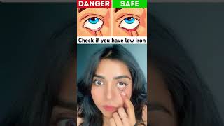 Check yourself sign ofiron deficiencyytshorts viralvideo disease irondeficiencyanemia [upl. by Neyugn]