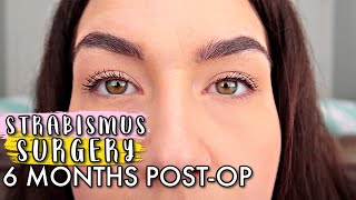 ESOTROPIA STRABISMUS SURGERY UPDATE 6 MONTHS POSTOP 2020  STRABISMUS SURGERY Before And After [upl. by Giverin]