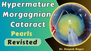 Hypermature Morgagnian cataract amp Horizontal chop technique Pearls revisited  Dr Deepak Megur [upl. by Gnouc11]