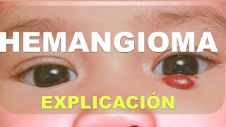 Qué es un hemangioma infantil [upl. by Ofloda]