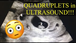 QUADRUPLETS ULTRASOUND  LOU YZA [upl. by Nahtan]