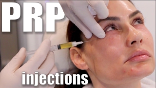 PRP Injections to Face and Neck Blood Facial [upl. by Auqeenahs]