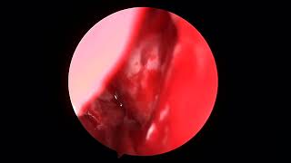 ENDOSCOPIC EXCISION OF DENTIGEROUS CYST [upl. by Eelahc993]