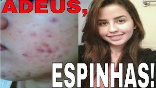 Como me livrei da acne sem Roacutan  O segredo do Peróxido de Benzoíla [upl. by Aleacin]