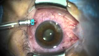 Diathermy to Seal Leaking Sclerotomies in SmallGauge Vitrectomy [upl. by Semreh]