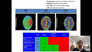 Teil 1 von 2 Befundung von CTPerfusion in NUR 4 Minuten lernen [upl. by Aicatsue]