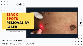 Black Spots Removal By Laser  Dark Spots on Face Treatment  Skin Care Tips  Dr Anvika Mittal [upl. by Ahsemak]