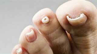 How Excilor Fungal Nail Treatment works  Now in UK [upl. by Dolli]