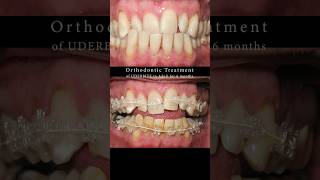 Underbite in Adults  six months treatment smile timelapse BRACES [upl. by Filip]