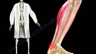 Achilles Tendon Stress amp Strain  Everything You Need To Know  Dr Nabil Ebraheim [upl. by Duarte383]