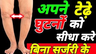 टेढ़े घुटनों को सीधा करे Knee Contractureघुटनों का गैप बढ़ाएBow Leg Treatment [upl. by Calia]