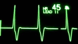 Accelerated Ventricular Rhythm AVR [upl. by Naruq]