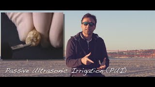 Passive or Active Ultrasonic Activation of Irrigation [upl. by Inge912]