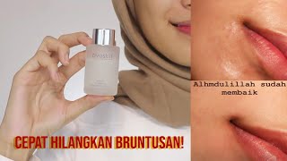 CARA CEPAT MENGHILANGKAN BRUNTUSAN Avoskin PHTE Review [upl. by Enotna]