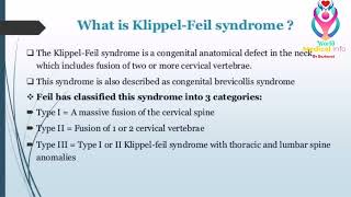 klippel Feil syndrome [upl. by Granniah612]