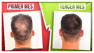 RECUPERA SU PELO en 3 MESES con DUTASTERIDE y MINOXIDIL ORAL [upl. by Dilahk]